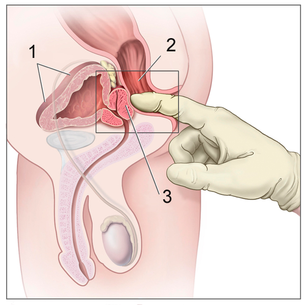 Schéma d'un toucher rectal pour diagnostiquer le cancer de la prostate.